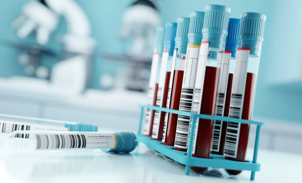 Blood Test to Identify People at High Risk for Lung Cancer